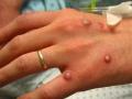 Monkeypox : अमेरिकेत आढळला 'मंकीपॉक्स'चा पहिला रुग्ण; काय आहे या आजाराची लक्षणे? जाणून घ्या, सविस्तर... - Marathi News | america monkeypox threat of new disease first case surfaced in america all you need to know | Latest health News at Lokmat.com