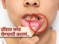 तोंडात फोड येण्याची पाहा कारणं, ५ गोष्टींमुळे होतो तोंडात अल्सर-रोज जेवण करणं मुश्किल - Marathi News | Mouth ulcers can also be caused by these 5 health problem | Latest sakhi News at Lokmat.com