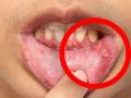 तोंडात फोड येण्याची पाहा कारणं, ५ गोष्टींमुळे होतो तोंडात अल्सर-रोज जेवण करणं मुश्किल - Marathi News | Mouth ulcers can also be caused by these 5 health problem | Latest sakhi News at Lokmat.com