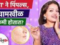 कांद्याचा रस चेहऱ्यावर कसा लावायचा | How to Use Onion for Pimples | How to Remove Pimples | - Marathi News | How to apply onion juice on face How to Use Onion for Pimples | How to Remove Pimples | | Latest beauty Videos at Lokmat.com