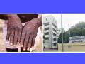 Monkeypox: मंकीपाॅक्सबाबत पुण्यातील नायडू हाॅस्पिटलला सूचना; संशयित रुग्ण आढळल्यास... - Marathi News | Notice to Naidu Hospital in Pune regarding monkey pox If a suspicious patient is found ... | Latest pune News at Lokmat.com