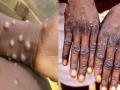 Monkey Pox Prevention Guidelines: Monkey Pox चं सरकारला टेन्शन! आरोग्य मंत्रालयानं व्यक्त केली चिंता, जारी केल्या गाइडलाइन्स - Marathi News | monkey pox spreading worldwide health ministry expressed concern new guideline released | Latest national News at Lokmat.com
