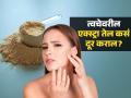 तेलकट त्वचा-चेहऱ्यावर पिंपल्सचं जंगल होईल गाबय, ५ सोपे उपाय- ना १ रुपया खर्च-ना साईड इफेक्ट - Marathi News | How to get rid of oily skin try these effective remedies | Latest sakhi News at Lokmat.com