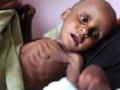 पश्‍चिम वर्‍हाडात बळावतेय बालकुपोषण - Marathi News | Childhood abuse in West Wahadas | Latest akola News at Lokmat.com