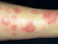 तणावामुळेही ‘इसब’ होऊ शकतो - Marathi News | Tension can also cause eczema | Latest nagpur News at Lokmat.com