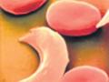 सिकलसेल-थॅलेसेमियाच्या रुग्णांना विशेष रक्तपुरवठा - Marathi News | Special blood supply to patients with sickle-thalassemia | Latest nagpur News at Lokmat.com