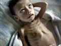 औरंगाबाद जिल्ह्यालाही कुपोषणाचा विळखा! - Marathi News | Aurangabad district also got malnutrition! | Latest maharashtra News at Lokmat.com