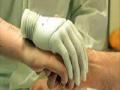 तुटलेल्या दोन्ही हातांचे यशस्वी प्रत्यारोपण ! - Marathi News | Successful transplant of broken hands! | Latest national News at Lokmat.com