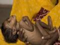 ठाणे,पालघर : १०६४५ बालके कुपोषित - Marathi News | Thane, Palghar: 10645 malnourished children | Latest mumbai News at Lokmat.com