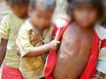 कुपोषणाचा विळखा कायमच - Marathi News | Forecasting of malnutrition is always possible | Latest gadchiroli News at Lokmat.com
