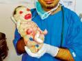 नागपुरात ‘हरक्विलीन’ बाळाचा जन्म - Marathi News | The birth of the child 'Harqilain' in Nagpur | Latest nagpur News at Lokmat.com
