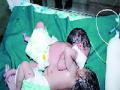 एक हृदय, यकृत असलेल्या सयामी जुळ्यांचा लातुरात जन्म - Marathi News | Birth of a heart, liver symmetric sex | Latest maharashtra News at Lokmat.com