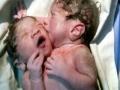 सायन रुग्णालयात जन्मले सयामी जुळे - Marathi News | Siamese twins born in Sion hospital | Latest mumbai News at Lokmat.com