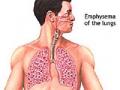 फुफ्फुसाच्या कॅन्सरचे रुग्ण वाढताहेत - Marathi News | Patients with lung cancer are growing | Latest nagpur News at Lokmat.com