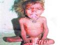 कुपोषित मुलांचे प्रमाण चौपट - Marathi News | The malnourished children are four times the size | Latest maharashtra News at Lokmat.com