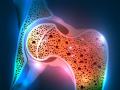 हाडांच्या ठिसुळतेमुळे वाढतोय ‘आॅस्टियोपोरोसिस’चा धोका! - Marathi News | Bone thickening increases the risk of 'osteoporosis'! | Latest akola News at Lokmat.com