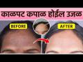 काळपट कपाळासाठी Serum | Serum for Forehead Pigmentation | Remedies For Dark Pigmentation - Marathi News | Serum for Dark Forehead Serum for Forehead Pigmentation | Remedies For Dark Pigmentation | Latest beauty Videos at Lokmat.com