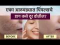 एका आठवड्यात पिंपल्सचे डाग कसे दूर होतील? | How To Get Rid Of Pimples | Home Remedies For Pimples - Marathi News | How to get rid of pimples scars in a week? | How To Get Rid Of Pimples | Home Remedies For Pimples | Latest health Videos at Lokmat.com