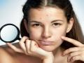 पिंपल्समुळे हैराण आहात?; 'या' घरगुती उपायांनी करा दूर - Marathi News | If you want to get rid of pimples then follow these home remedies | Latest beauty News at Lokmat.com