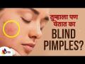 तुम्हाला पण येतात का Blind Pimples ? What's Blind Pimple? Home Remedy | Lokmat Sakhi - Marathi News | Do you also get Blind Pimples? What's Blind Pimple? Home Remedy | Lokmat Sakhi | Latest oxygen Videos at Lokmat.com