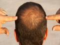 Hair Fall : एक्सपर्टनुसार हा एक पदार्थ केसगळतीचं आहे मुख्य कारण, खाता-पिताना घ्या काळजी! - Marathi News | Hair Fall : Common type androgenetic alopecia causes treatment sodium | Latest health News at Lokmat.com