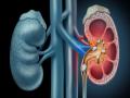 शरीरात दिसतील हे बदल तर वेळीच व्हा सावध, Kidney Damage चे असू शकतात संकेत - Marathi News | Sign of kidney Damage : These are the symptoms of kidney disease and damage | Latest health News at Lokmat.com