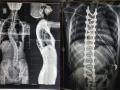पाठीला बाक असलेली मुलगी जगु लागली ताठ मानेने - Marathi News | The girl with the back arm started to live with a stiff neck | Latest pune News at Lokmat.com