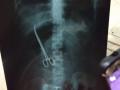 बापरे... ऑपरेशननंतर 3 महिने महिलेच्या पोटातच होती कात्री!  - Marathi News | Hyderabad: Doctors forget scissors inside patient’s stomach, acute pain reveals lapse | Latest national News at Lokmat.com