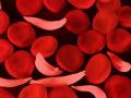 सिकलसेल जनजागृती सप्ताहांतर्गत आजपासून तपासणी मोहीम - Marathi News | Sickle Cell Awareness Week: investigation from today in Akola | Latest akola News at Lokmat.com