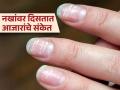 आरोग्याबाबत खूप काही सांगतात नखं, जाणून घ्या कोणत्या आजारात कशी दिसतात नखं! - Marathi News | Expert tells how to identify diseases signs on nails | Latest sakhi News at Lokmat.com