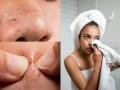 टॉवेलच्या मदतीने नाकावरील ब्लॅकहेड्स काढा सेकंदात! विसरा पार्लरची झंझट - त्वचा दिसेल कायम तरुण... - Marathi News | how to remove blackheads at home simple towel method for blackheads blackhead removal home remedy towel trick to remove blackheads natural way to clean blackheads natural way to clean blackheads | Latest sakhi News at Lokmat.com