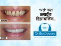 दातांमध्ये गॅप, दात पुढे म्हणून तुमचं हसूच गायब झालंय? ‘असं’ करा स्माईल डिझायनिंग.. - Marathi News | orthosquare clinic care now pay later, dental chain and importance of smile designing | Latest sakhi News at Lokmat.com