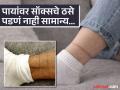 सॉक्स काढताच पायांच्या त्वचेवर दिसतात ठसे - चट्टे? नॉर्मल समजण्याची करू नका चूक, पाहा कशाचे संकेत - Marathi News | Why do marks appear on your feet, know the causes and how to prevent it | Latest health News at Lokmat.com