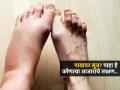 पायांवर नेहमी सूज-पायात गोळे येतात? शरीर सांगतं तुम्ही आजारी आहात कारण.. - Marathi News | Diseases Signs On Feet According To Doctor How To Identify Disease By Feet | Latest sakhi News at Lokmat.com