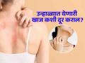 उन्हामुळे त्वचेवर येणारी खाज आणि घामोळ्या दूर करण्याचे सोपे उपाय, महागड्या क्रीमची पडणार नाही गरज! - Marathi News | These home remedies will help you to get rid of heat rashes or prickly heat | Latest sakhi News at Lokmat.com