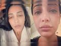 Shruti Haasan Shocking Photos:डोळे सुजलेले, केस विस्कटलेले, श्रुती हसनचे ते फोटो व्हायरल, पाहून चाहत्यांना बसला धक्का - Marathi News | Shruti Haasan face swollen in her non perfect and unfiltered selfies see instagram post | Latest filmy News at Lokmat.com