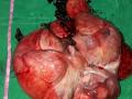 नागपुरात महिलेच्या पोटातून काढला १८ किलोचा ट्युमर - Marathi News | 18 kilogram tumor removed from the stomach of a woman in Nagpur | Latest nagpur News at Lokmat.com