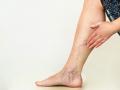 varicose veins : पायावरच्या काळ्यानिळ्या शिरांचं म्हणणं काय? व्हेरिकोज व्हेन्ससाठी करायचे उपचार आणि फिजिओथेरपी - Marathi News | varicose veins causes symptoms treatment physiotherapy and prevention, what to know | Latest sakhi News at Lokmat.com