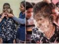 मुलाच्या चेहऱ्यावर प्राण्यांसारखे आले केस, लोक दगड मारायचे, काय आहे हा आजार ? - Marathi News | hypertrichosis-syndrome-where-there-is-excessive-hair-growth-on-body-weather-male-or-female | Latest health News at Lokmat.com