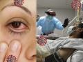 CoronaVirus New symptoms : कोरोना व्हायरसचा डोळ्यांवर होतोय गंभीर परिणाम; सुरूवातीला 'ही' लक्षणं दिसल्यास वेळीच सावध व्हा - Marathi News | Corona vaccine is doing wonders to some people and even protecting them against many diseases | Latest health News at Lokmat.com