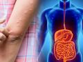 Hives causes symptoms : उन्हाळ्यात 'या' ८ गोष्टींमुळे तुमच्याही शरीरावर येऊ शकतं पित्तं; जाणून घ्या लक्षणांसह बचावाचे उपाय - Marathi News | Hives causes symptoms treatment and prevention of pitt | Latest health News at Lokmat.com