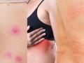 उन्हाळ्यात घामाने छातीखाली खाज येतेय? या उपायांनी मिळेल आराम - Marathi News | Easy home remedies for rashes and etching under breast | Latest sakhi News at Lokmat.com