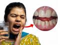 Dental Tips : रात्री अचानक दात दुखू लागला तर? डॉक्टरांनी सांगितले त्वरित आराम मिळवून देणारे उपाय - Marathi News | Dental Tips : Teeth pain in night tips to manage | Latest sakhi News at Lokmat.com