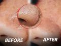Blackheads Removal Tips : खूप ब्लॅकहेट्स आलेत? थकल्यासारखे दिसताय? 'या' सोप्या उपायांनी ब्लॅकहेट्स घालवून मिळवा ग्लोईग चेहरा - Marathi News | Blackheads Removal Tips Skin care Tips : How to remove blackheads on nose with home remedies | Latest sakhi News at Lokmat.com