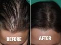 How to stop hair fall : केस खूप गळतात? टक्कल पडण्याची भीती सतावतेय? दाट, काळ्याभोर केसांसाठी डॉक्टरांनी सुचवले 7 उपाय - Marathi News | How to stop hair fall : Ayurvedic doctor reveals 5 most common causes of hair fall | Latest sakhi News at Lokmat.com