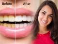 How to whiten yellow teeth : पिवळ्या दातांमुळे चारचौघात हसताना, बोलताना लाज वाटते? पांढऱ्या शुभ्र दातांसाठी या घ्या टिप्स - Marathi News | How to whiten yellow teeth : Yellow teeth make you feel embarrassed while laughing and talking? Here are some tips for whitening teeth | Latest sakhi News at Lokmat.com