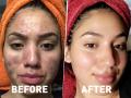 How to remove pimples : चेहरा काळवंडलाय, पिंपल्सचे काळे डागही खूप झालेत? ५ हेल्दी ड्रिंक्स, आठवडाभरात मिळेल ग्लोईंग स्किन - Marathi News | How to remove pimples from face : 5 herbal and healthy drinks to reduce acne problem | Latest sakhi News at Lokmat.com