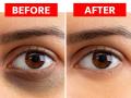 Dark Circles Solution : डोळ्यांखालच्या काळ्या वर्तुळांनी लूक बिघडवलाय? १० उपाय, गायब होतील डार्क सर्कल्स - Marathi News | Dark Circles Solution : Home remedies for dark circles easy ways to get rid of dark circles | Latest sakhi Photos at Lokmat.com