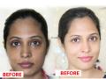 How To Remove Tan Effectively : उन्हामुळे त्वचेवर खूप टॅनिंग झालंय? १ उपाय करा, पार्लरला न जाताच मिळेल ग्लोईंग निखार - Marathi News | How To Remove Tan Effectively : Dermatologist reveals way to remove tanning | Latest sakhi News at Lokmat.com