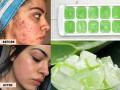 How To Remove Pimples Using Aloe Vera : चेहऱ्यावर खूप पिंपल्स, काळे डागही पडलेत? 'या' पद्धतीनं ॲलोवेरा आईस क्यूब लावा, कायम दिसेल ग्लोईंग चेहरा - Marathi News | How To Remove Pimples Using Aloe Vera :  How to make aloe vera ice cube for pimple skin | Latest sakhi News at Lokmat.com